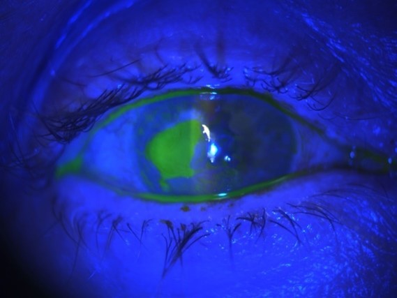 Read more about the article Is Moraxella Non-liquefaciens induced microbial keratitis related to mask wearing?